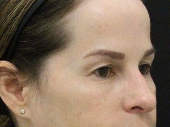 Forehead & Brow Lifts: Case 8 - Before
