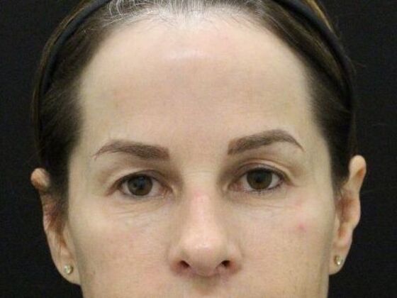 Forehead & Brow Lifts Case 8 - Before