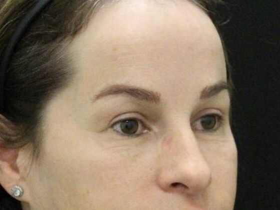 Eyelid Surgery: Case 25 - After