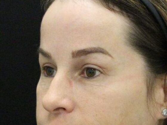 Eyelid Surgery: Case 25 - Before