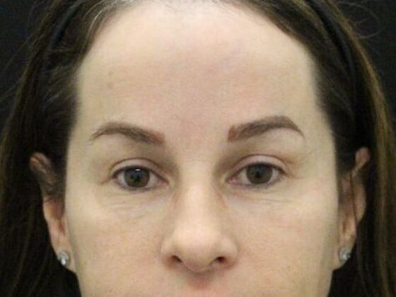 Eyelid Surgery: Case 25 - After