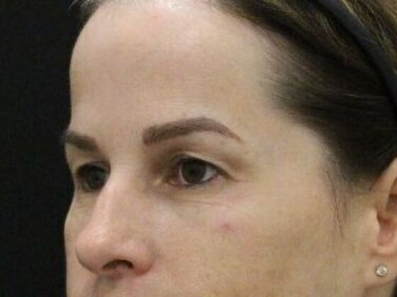 Eyelid Surgery: Case 25 - After