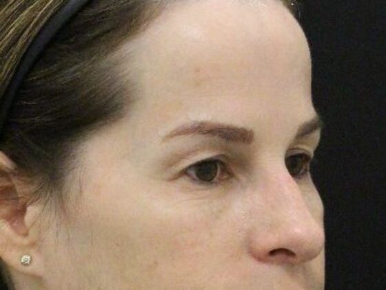 Eyelid Surgery: Case 25 - Before