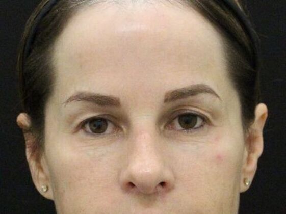 Eyelid Surgery: Case 25 - Before