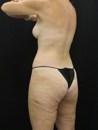 Tummy Tuck: Case 67 - After