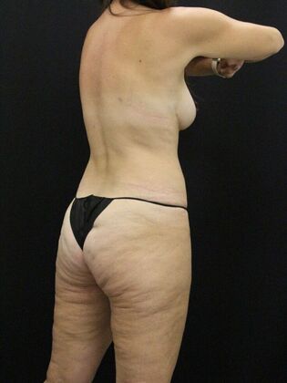 Tummy Tuck: Case 67 - After