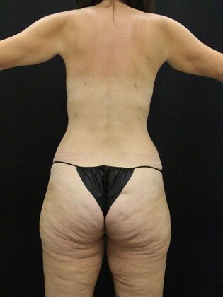 Tummy Tuck: Case 67 - After