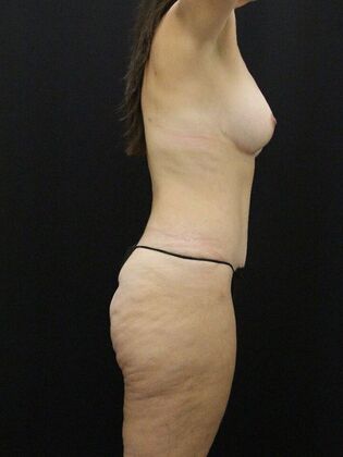 Tummy Tuck: Case 67 - After