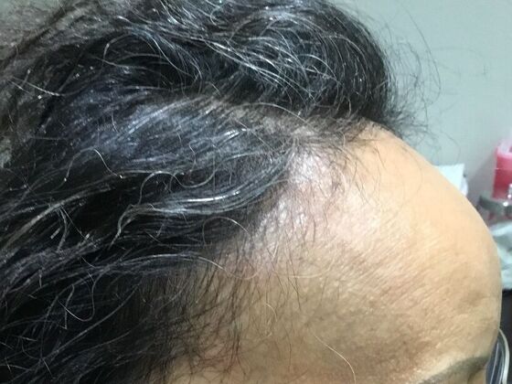 Advanced Non-Surgical Treatments Case 2 - After