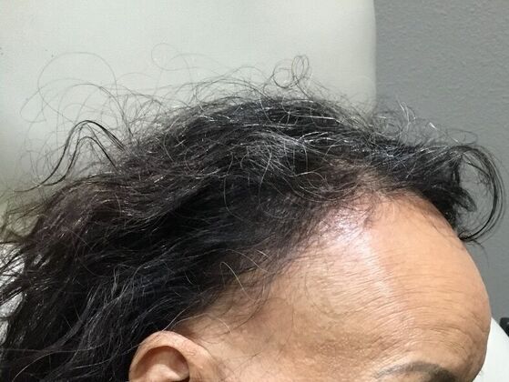 Advanced Non-Surgical Treatments Case 2 - Before