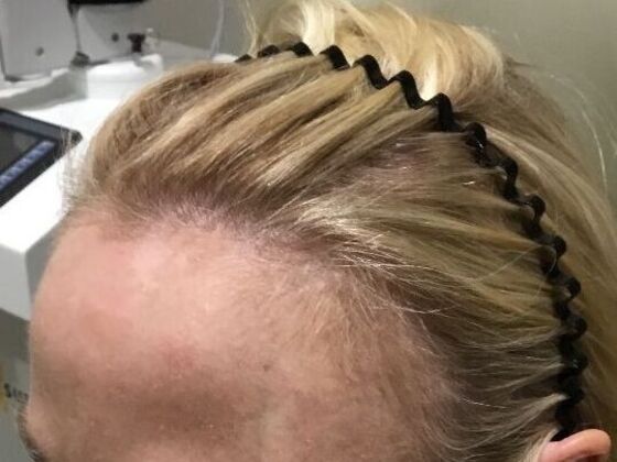 Advanced Non-Surgical Treatments Case 1 - Before