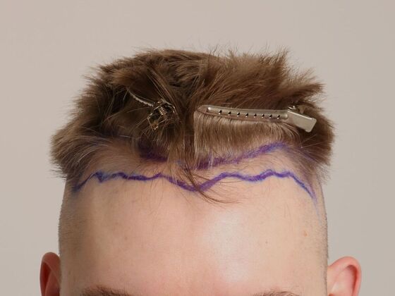 Male Before And After Hair Transplant Photos Hairline FUE (22) - Before