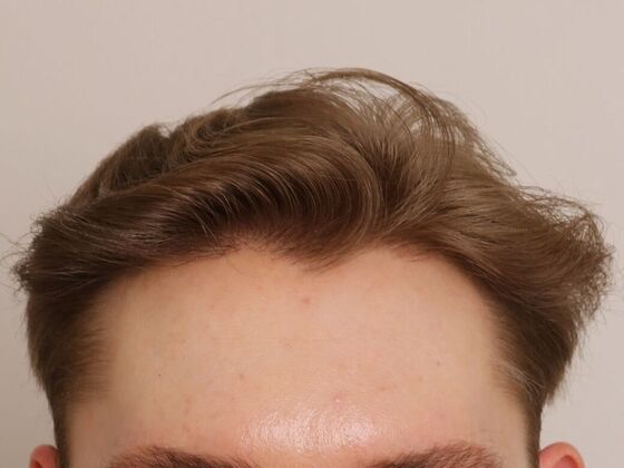 Male Before And After Hair Transplant Photos Hairline FUE (22) - After