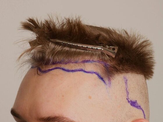 Hair Transplant - Male: Hairline FUE - Case 22 - Before FUE hair transplant