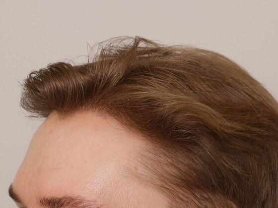 Hair Transplant - Male: Hairline FUE - Case 22 - After FUE hair transplant