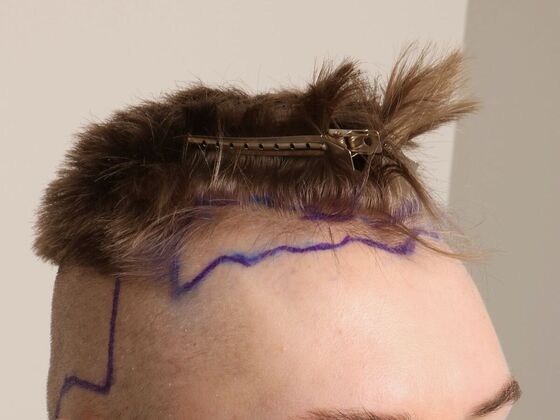 Hair Transplant - Male: Hairline FUE - Case 22 - Before FUE hair transplant