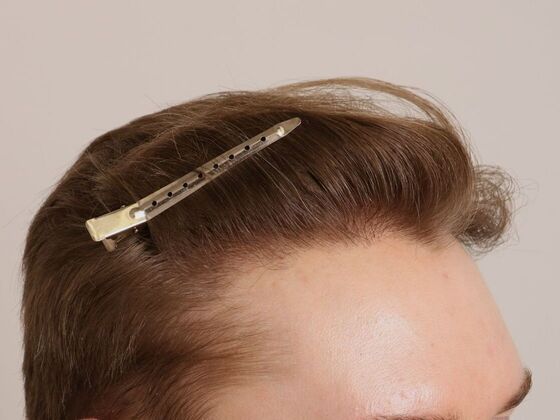 Hair Transplant - Male: Hairline FUE - Case 22 - After FUE hair transplant