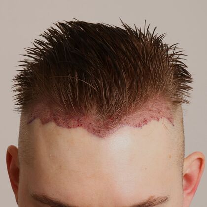 Hair Transplant - Male: Hairline FUE - Case 22 - Post-op FUE hair transplant