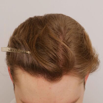 Hair Transplant - Male: Hairline FUE - Case 22 - After FUE hair transplant