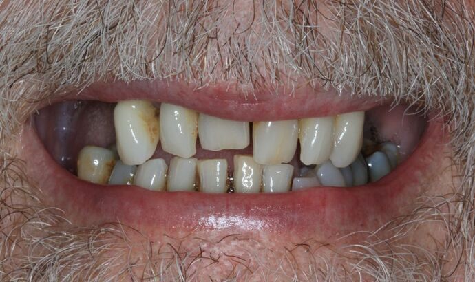 Hybrid Implant Dentures Case 7 - Before