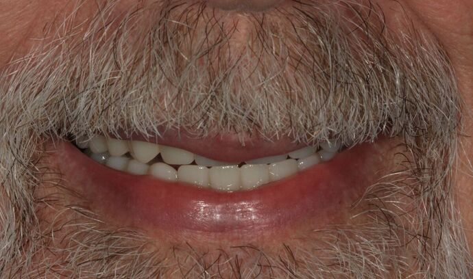 Hybrid Implant Dentures Case 7 - After