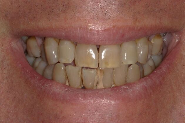 Hybrid Implant Dentures: Case 8 - Before