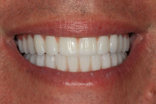Hybrid Implant Dentures: Case 8 - After