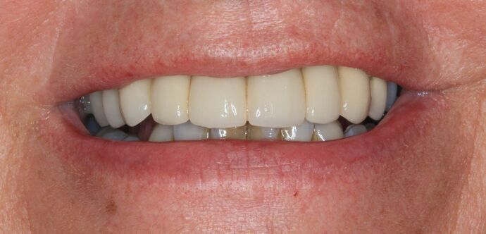 Hybrid Implant Dentures Case 9 - Before