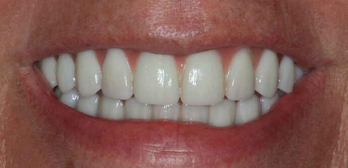 Hybrid Implant Dentures Case 9 - After