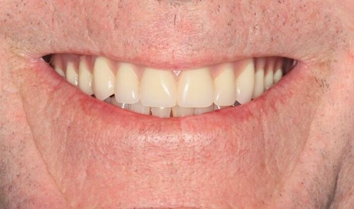 Hybrid Implant Dentures Case 10 - Before