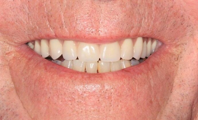 Hybrid Implant Dentures Case 10 - After