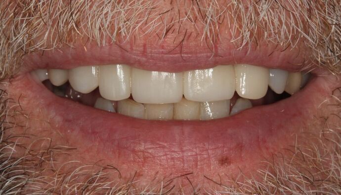 Hybrid Implant Dentures: Case 11 - Before