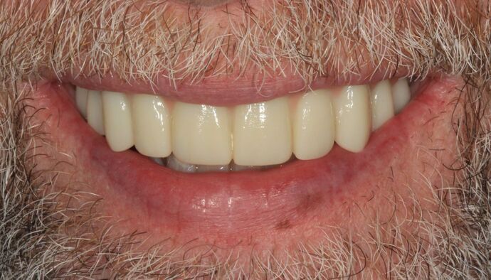 Hybrid Implant Dentures: Case 11 - After
