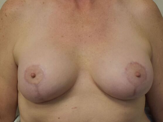 Breast Augmentation w/ Lift Case 621 - After