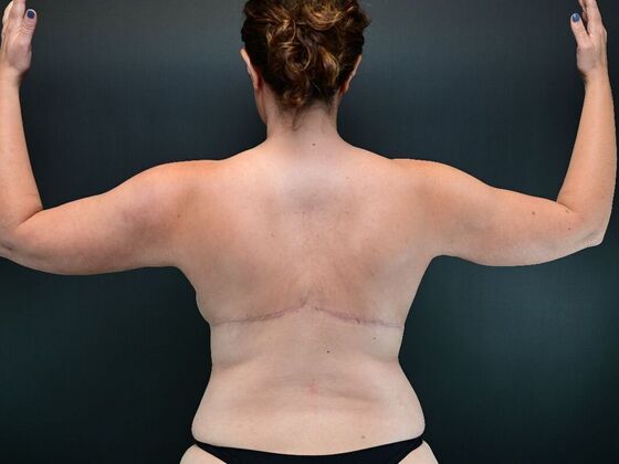 Torsoplasty Case 1 - After