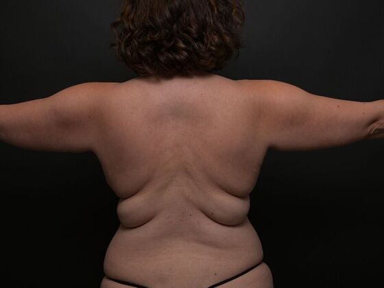 Torsoplasty: Case 1 - Before