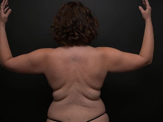 Torsoplasty Case 1 - Before