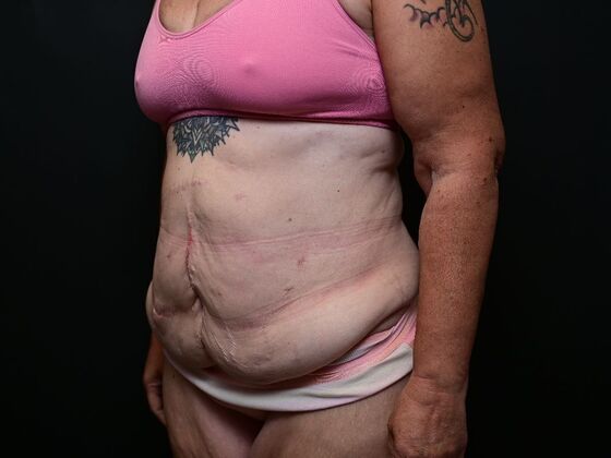 Torsoplasty: Case 2 - Before