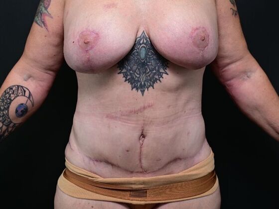 Torsoplasty Case 2 - After