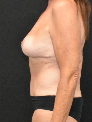 Mommy Makeover: Case 21 - After