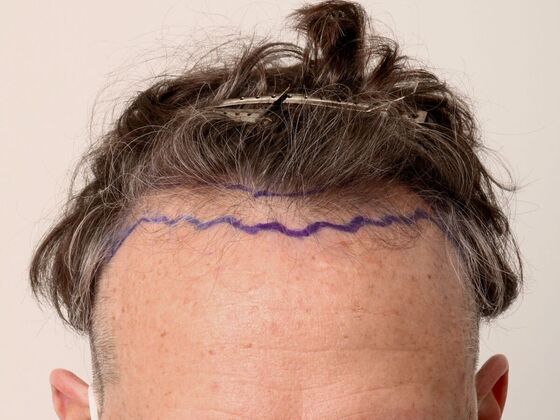 Hair Transplant - Male: Hairline FUE - Case 23 - Before FUE hair transplant