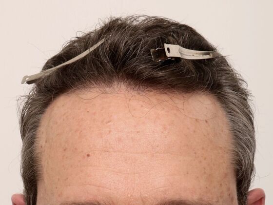 Hair Transplant - Male: Hairline FUE - Case 23 - After FUE hair transplant