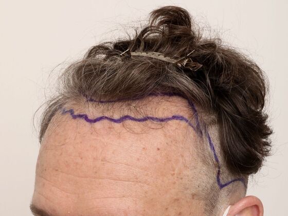 Hair Transplant - Male: Hairline FUE - Case 23 - Before FUE hair transplant