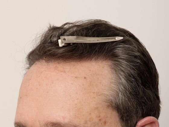 Hair Transplant - Male: Hairline FUE - Case 23 - After FUE hair transplant