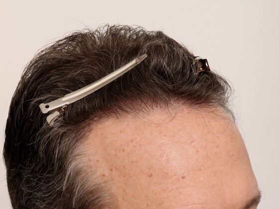 Hair Transplant - Male: Hairline FUE - Case 23 - After FUE hair transplant