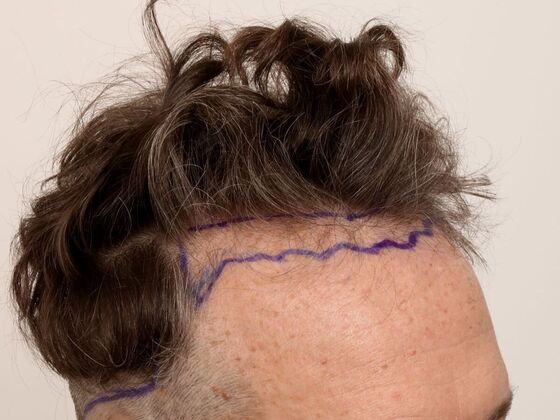 Hair Transplant - Male: Hairline FUE - Case 23 - Before FUE hair transplant