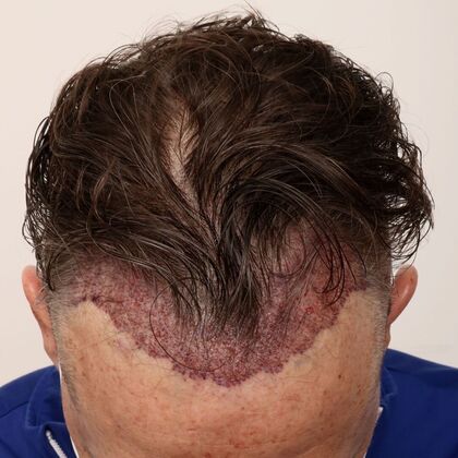 Hair Transplant - Male: Hairline FUE - Case 23 - Post-op FUE hair transplant