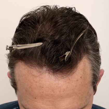 Hair Transplant - Male: Hairline FUE - Case 23 - After FUE hair transplant