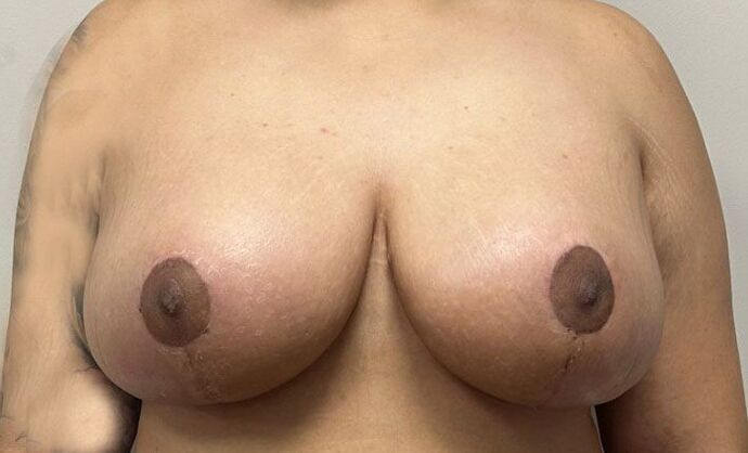 Breast Reduction: Case 203 - After
