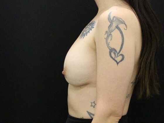 Breast Revision: Case 18 - Before